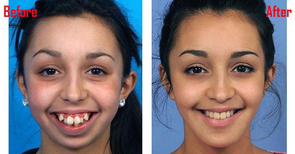 一张对比图告诉你牙齿矫正的重要性!